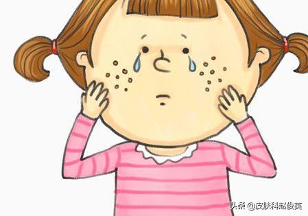 异维a酸治疗痘痘副作用大吗,须疮吃异维a酸有用吗