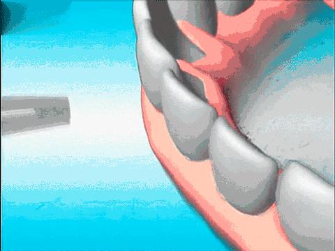 不洗牙去除牙结石的实用方法,牙结石特别严重如何洗牙