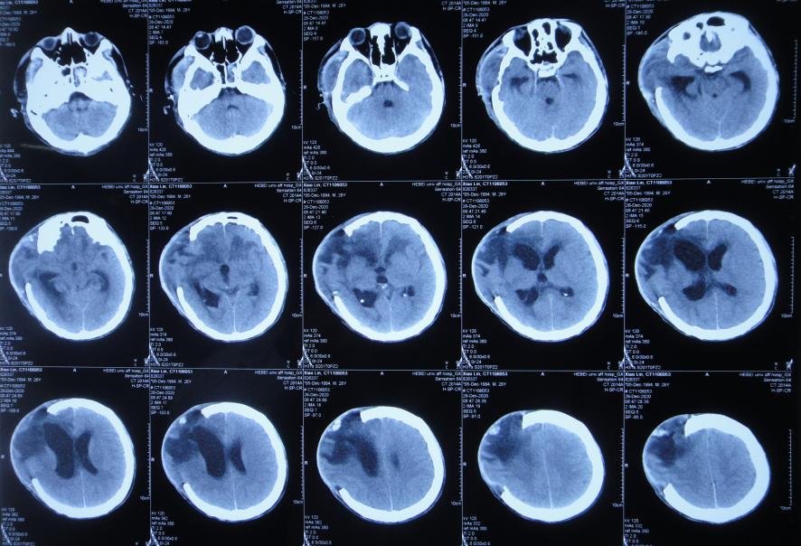 开颅手术后颅内细菌感染图片,外伤开颅手术后脑积液能恢复吗
