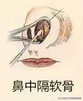 鼻中隔耳软骨隆鼻有哪些优缺点,鼻中隔隆鼻是取鼻中隔软骨吗