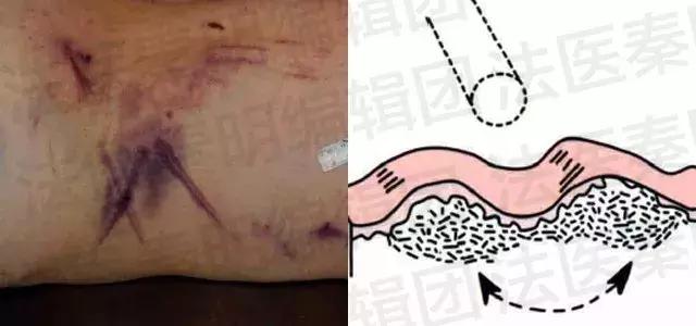 法医讲述尸体分析,法医在尸体中找到真相