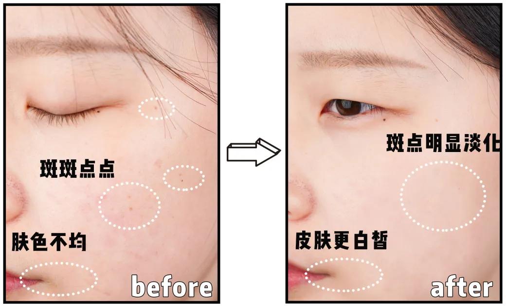 脸上的斑可以通过医美去掉吗,脸上长斑了能用激光去除吗