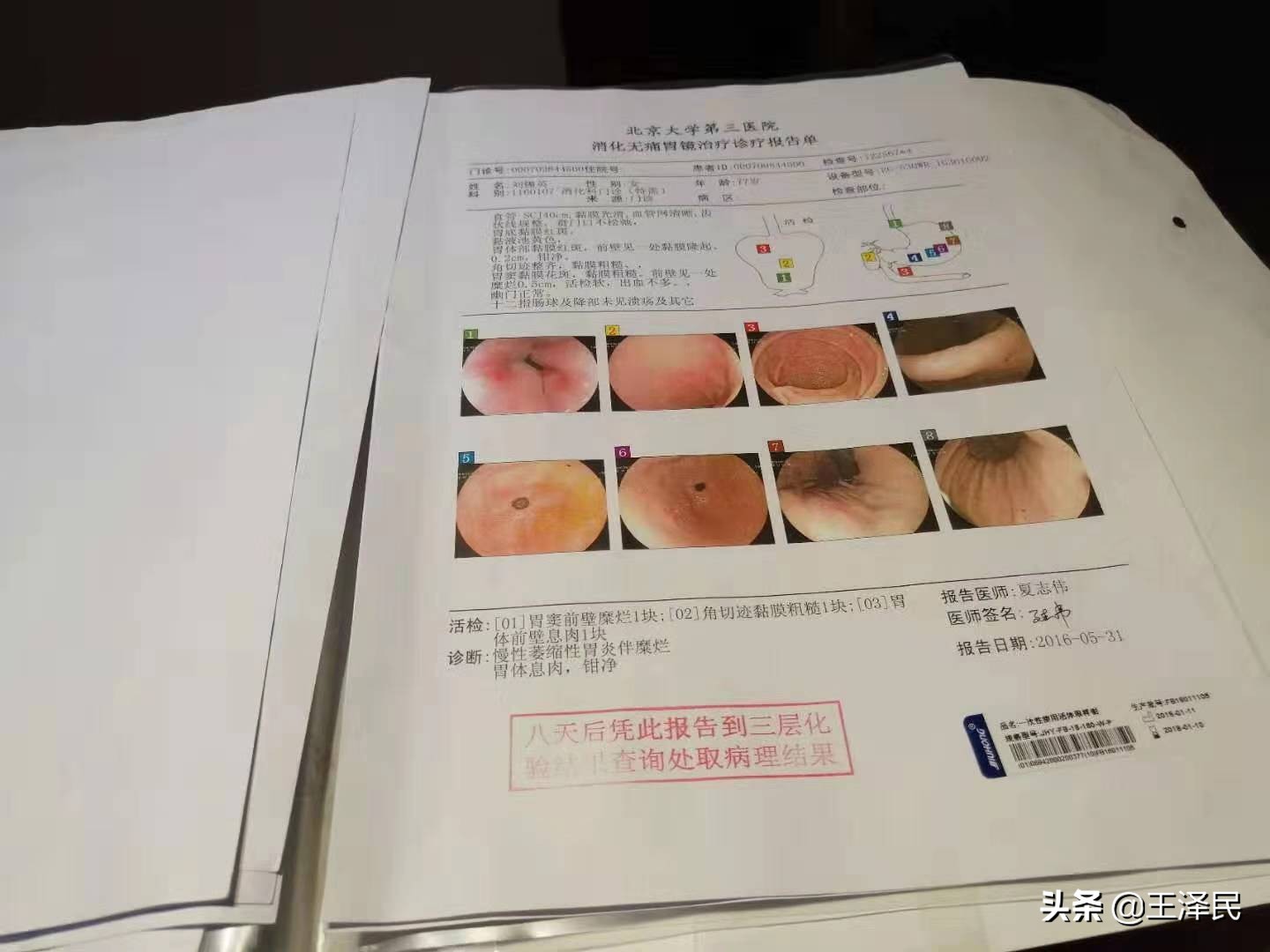 30多年胃病一年犯几次怎么办,30多年的老胃病太难治