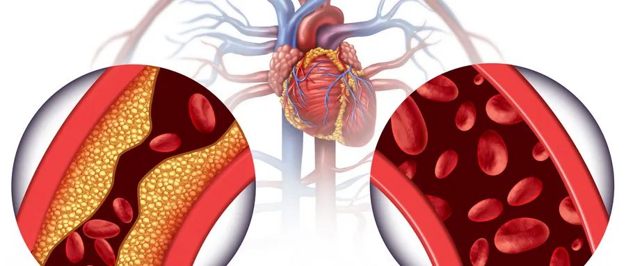 同型半胱氨酸高的人有哪些特征,同型半胱氨酸升高需警惕几种疾病