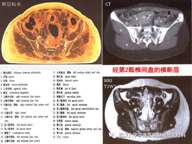 女性盆腔解剖与断层影像