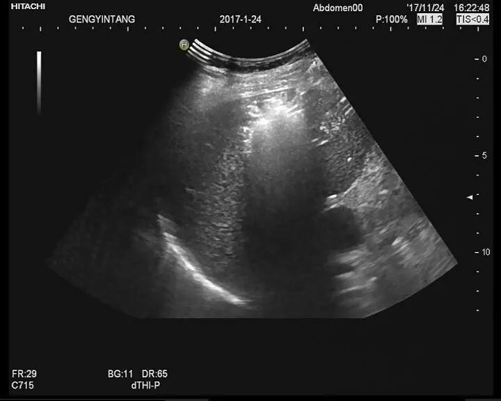手术治疗溃疡性结肠炎的费用,溃疡性结肠炎切除手术费用是多少