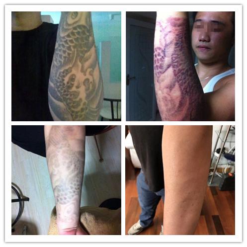 洗纹身咨询李医生,昆明李医生洗纹身是真的吗