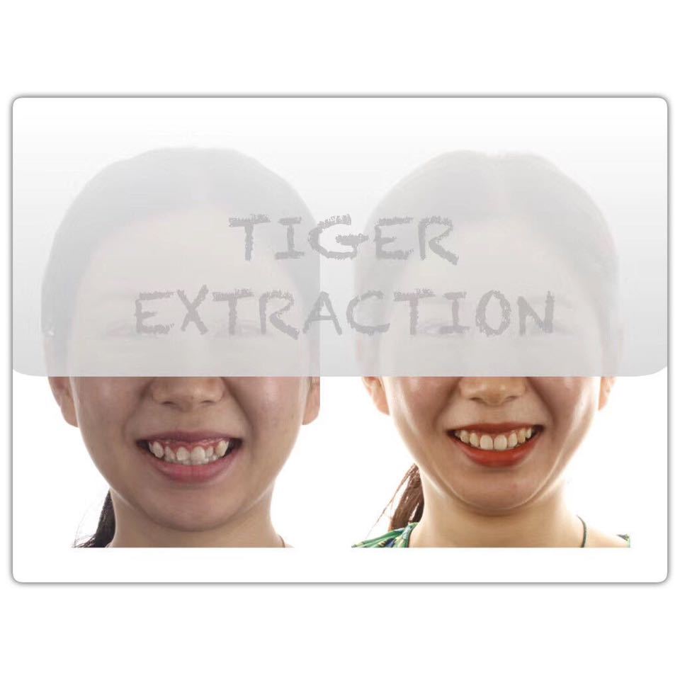 隐适美矫正危害,隐适美矫正真实案例