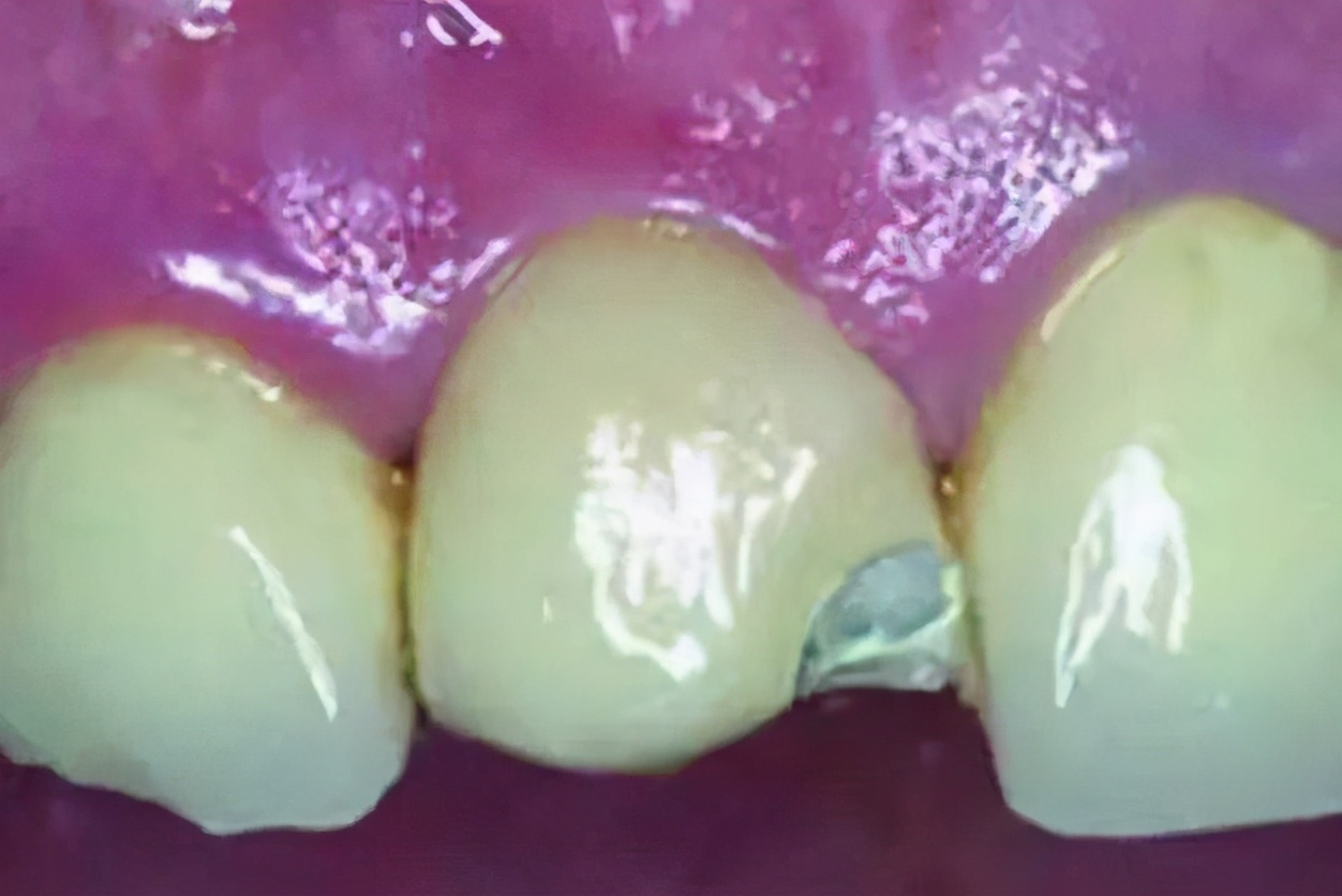 有多少人做了烤瓷牙后悔呀,为什么越来越多人放弃烤瓷牙