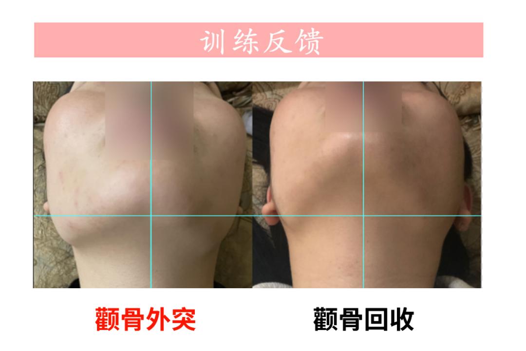 下颌偏歪会引起哪边脸大,下颌紊乱跟大小脸有关系