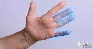 为什么有些人会手脚发麻,为什么我们会觉得手脚麻木