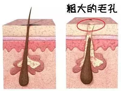 化妆会让皮肤毛孔粗大吗,长期化妆会让毛孔越来越粗大吗