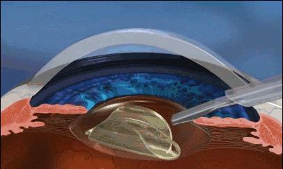 眼科医生郭海科治疗白内障,郭海科白内障