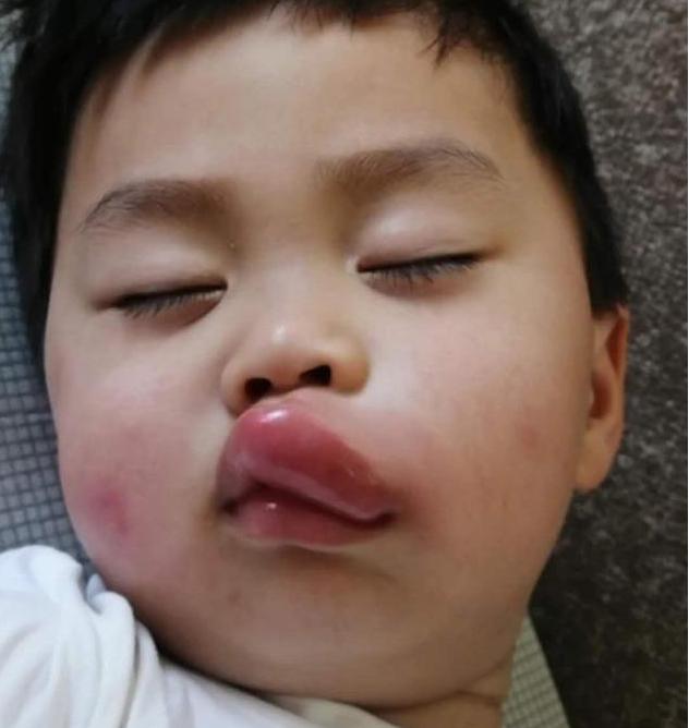 4岁小孩嘴巴突然肿成香肠嘴原因,孩子嘴巴肿得像香肠