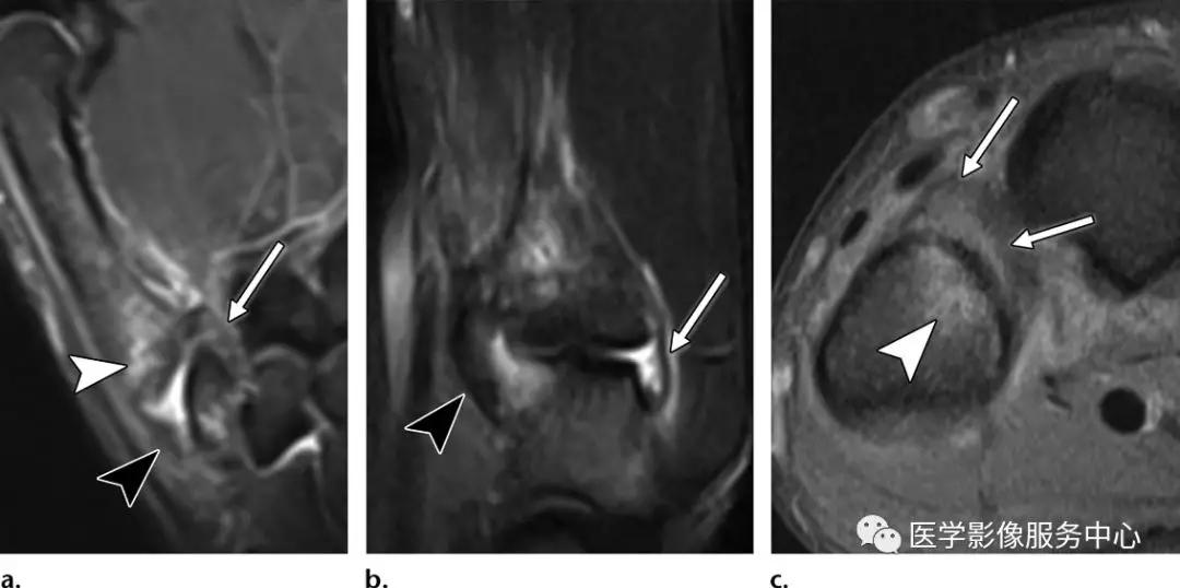 手腕撕脱性骨折一年了还隐隐作痛,手腕三角骨撕脱骨折症状有哪些
