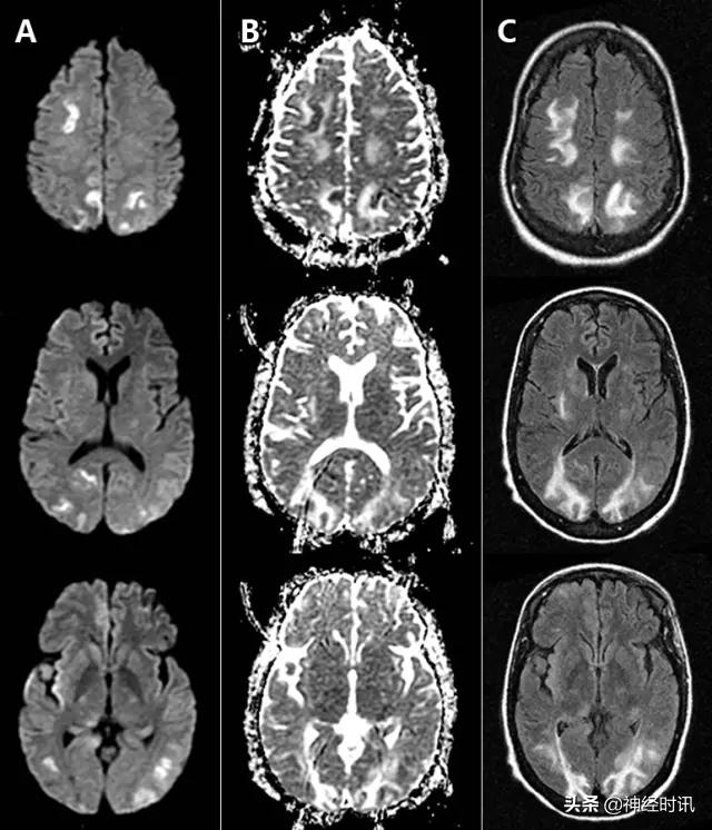 脑卒中病历诊断书图片,脑卒中影像判断技巧图解电子版