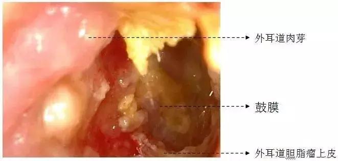 “耳屎”太多被同事吐槽!杭州漂亮姑娘去医院一查,吓得直掉眼泪