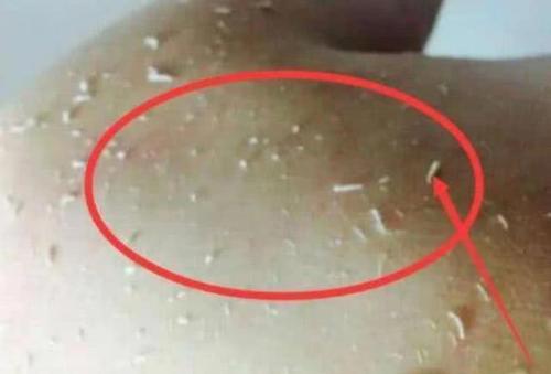 洗澡搓泥后起疙瘩,洗澡时搓出来的泥是怎么回事