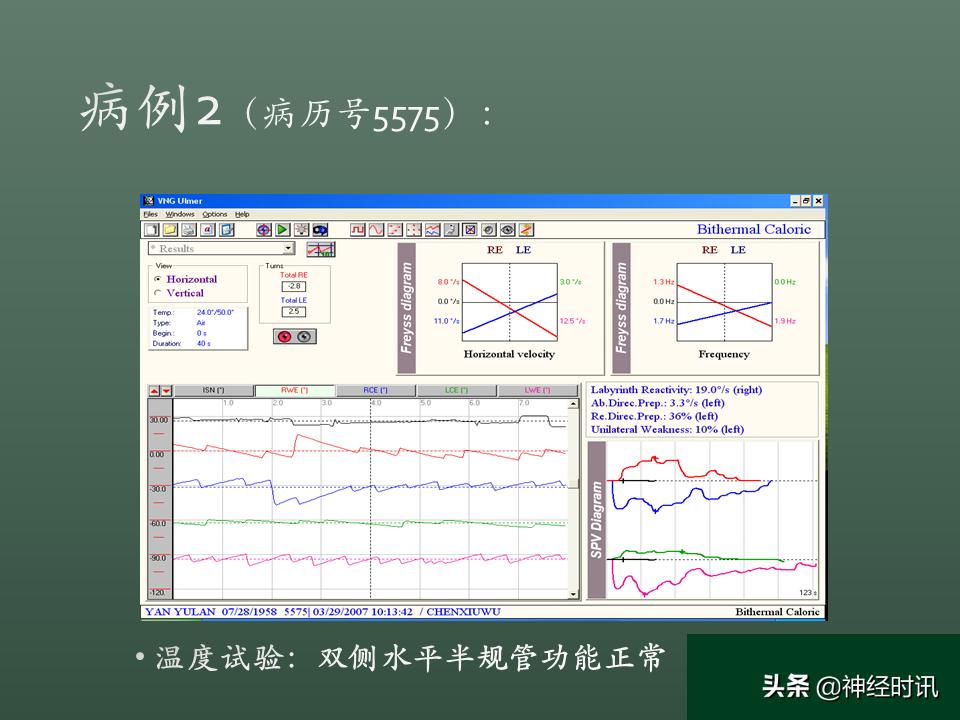 良性位置性眩晕诊断和治疗指南,良性阵发性位置性眩晕的诊断标准
