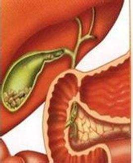 体检发现患有双肾囊肿胆囊息肉,胆囊囊肿不做手术有什么治疗方法