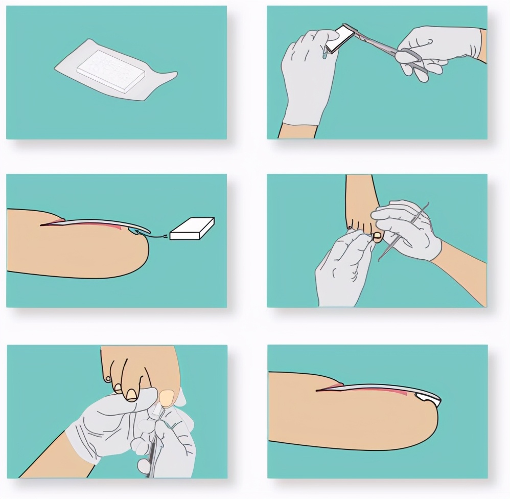 甲沟炎注意事项及禁忌,甲沟炎属于哪科疾病