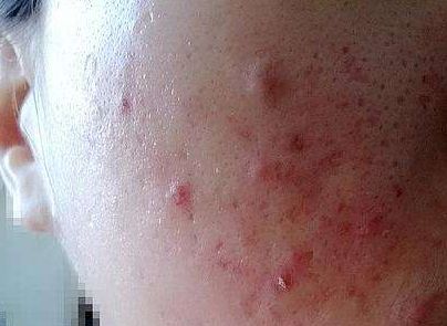 脸上的痘痘痘印怎么消下去,红痘印一直消不下去怎么办