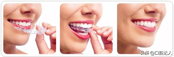 牙齿矫正步骤流程,牙齿矫正怎么操作
