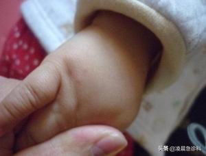 宝宝长水痘怎么处理好得快,小孩子水痘要是没发好会怎么样