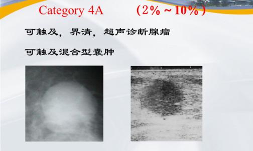乳腺结节bi-rads分级依据,国内乳腺结节bi-rads分级标准