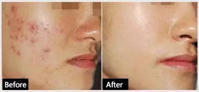 哪种果酸治闭口最好用,什么果酸对闭口有用