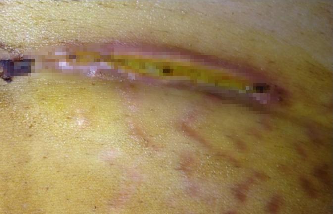 剖腹产28天伤口结痂,剖腹产38天突然出鲜血了