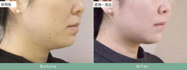 如何瘦双下巴和婴儿肥,小孩怎么快速减掉双下巴