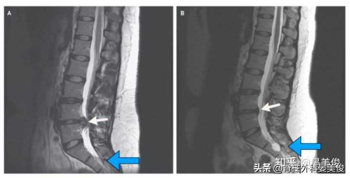 腰椎间盘突出能不能跳舞,腰椎间盘突出能不能自愈