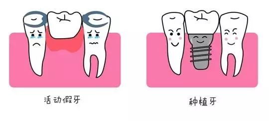 缺牙补牙疼不疼,缺牙补牙多少钱一颗