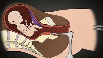 堕胎到底有没有恶果,堕胎真的那么可怕吗