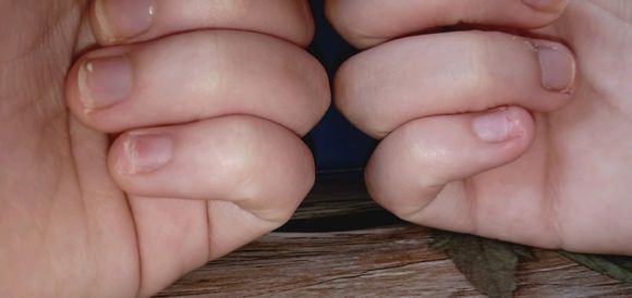 孩子抠指甲心理,孩子抠指甲严重的危害