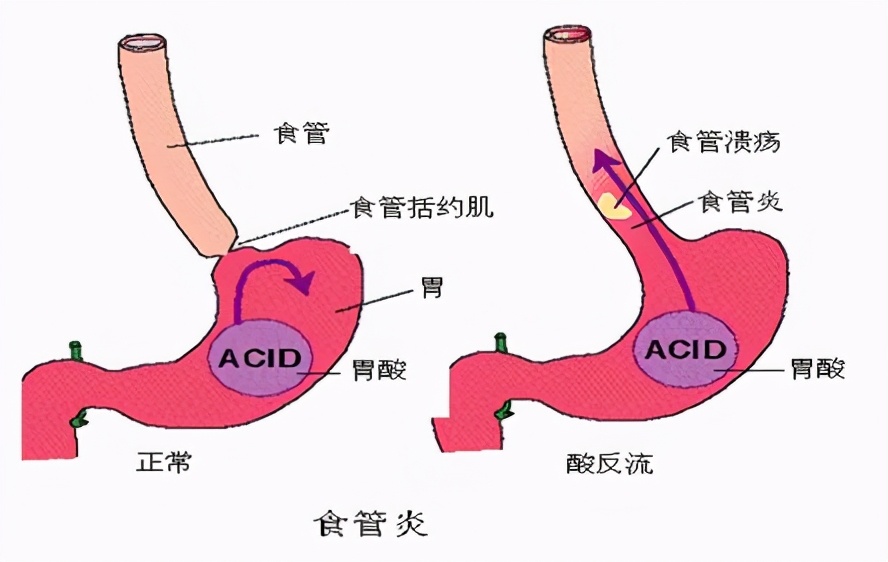 胃食管反流引起咽喉炎用药,孩子胃食管反流性咳嗽怎么用药