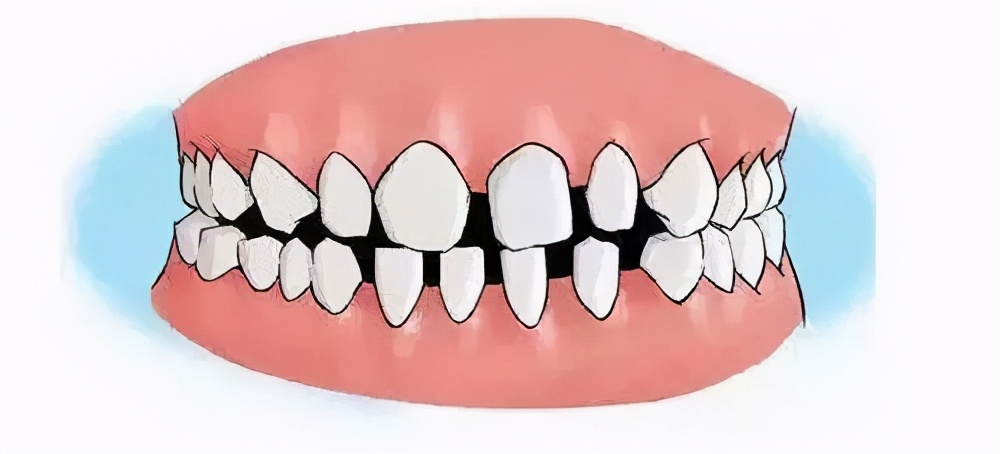 牙齿断裂会导致什么危害？该怎么解决？