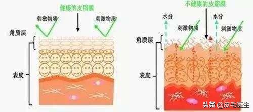 冬天换季干燥脱皮爆痘,冬季干燥泛红脱皮敏感爆痘怎么办