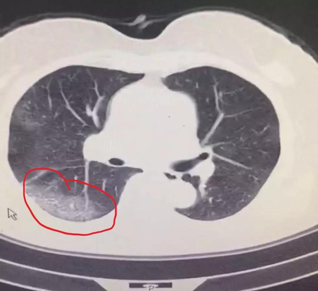 高血压合并新冠病例,高血压合并新冠肺炎
