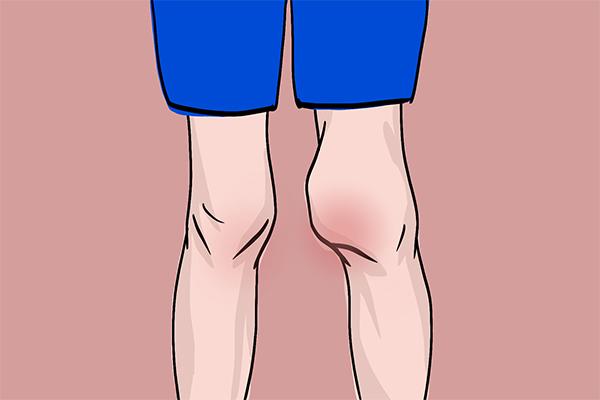 世界血友病日科普动画视频,世界血友病日什么是血友病