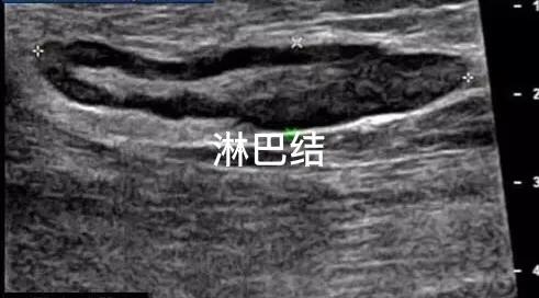 颈部摸到淋巴结凸起是肺坏了吗,颈部淋巴结肿大良性和恶性的区别