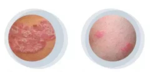 乳房癣和乳房湿疹区别,太胖乳房下面老起湿疹