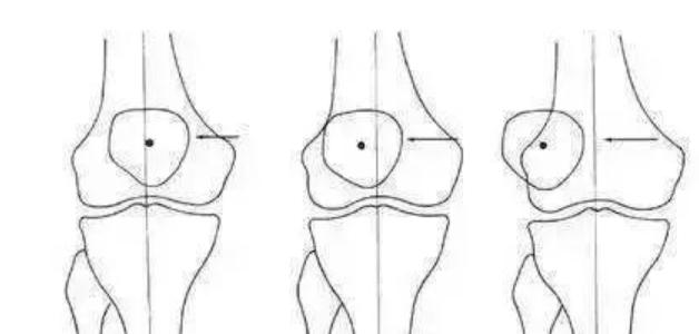 髌骨痛不能弯曲怎么办,髌骨不疼但脱位了怎么治