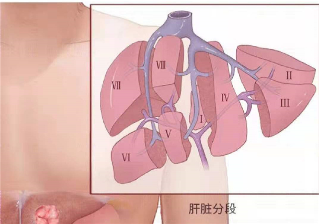 晚期肝癌常见的并发症,肝癌身体有什么预兆