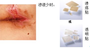 压疮敷料的选择及使用,褥疮敷料的正确使用方法