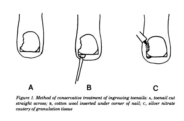 什么原因导致脚趾甲老是嵌甲,脚趾甲老是长到肉里怎么治疗啊