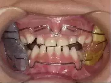 地包天早期矫正最佳时间,地包天10-15岁矫正是最佳年龄吗