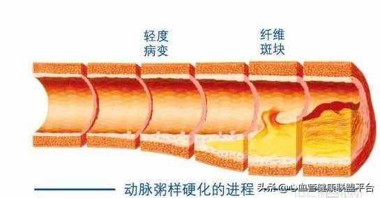 硬核科普｜血压检测不能少，动脉硬化你知多少？