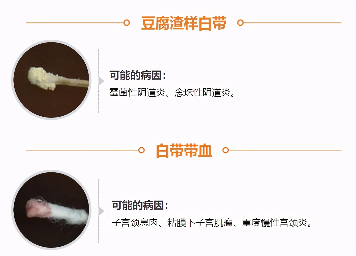 白带变黄或豆腐渣？这几种情况反映身体是否健康